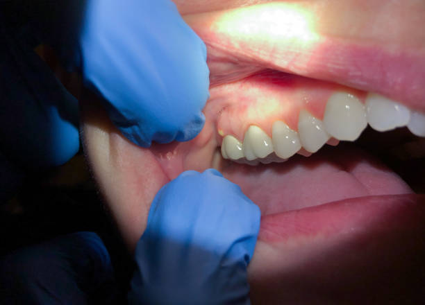 Best Emergency Treatment for Dental Infections or Abscesses in Beaver Dam, AZ